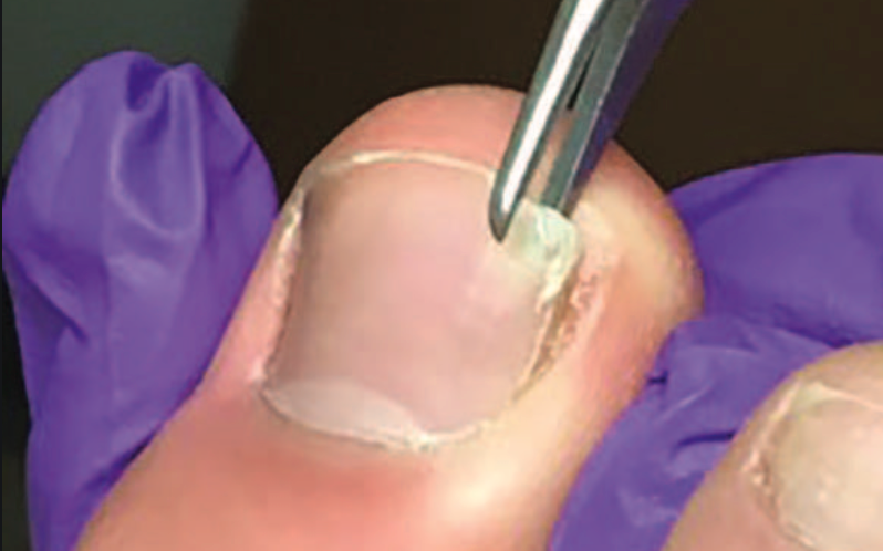 Fingertip Amputations & Finger Flaps - Hand - Orthobullets